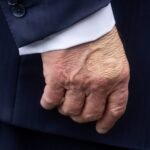A new dark bruise on his hand. Health concerns about Trump