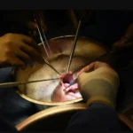 "Revolutionary step." Transplanting a pig's lung into a human body