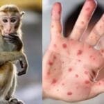 إنذار صحى فى المحيط الهندى.. تفشٍ متصاعد لجدرى القرود يرفع الإصابات فى مدغشقر إلى 78 حالة