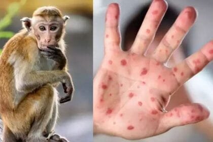 إنذار صحى فى المحيط الهندى.. تفشٍ متصاعد لجدرى القرود يرفع الإصابات فى مدغشقر إلى 78 حالة