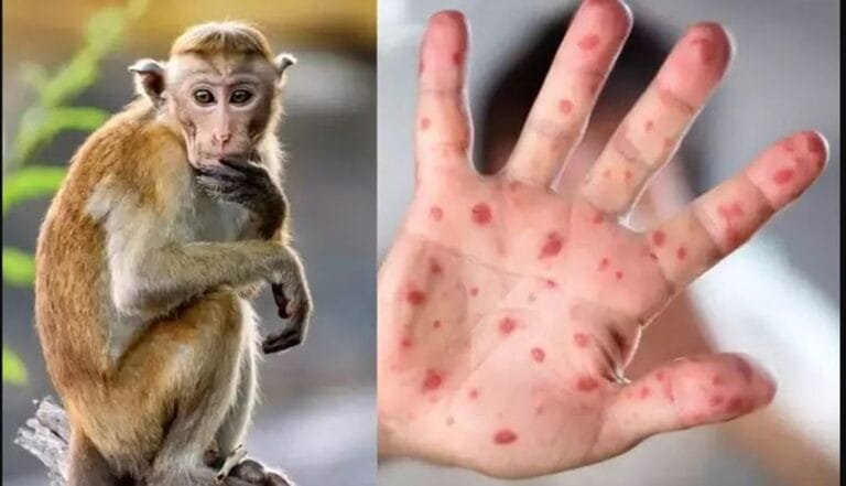 Health alert in the Indian Ocean: A rising outbreak of monkeypox raises infections in Madagascar to 78 cases.