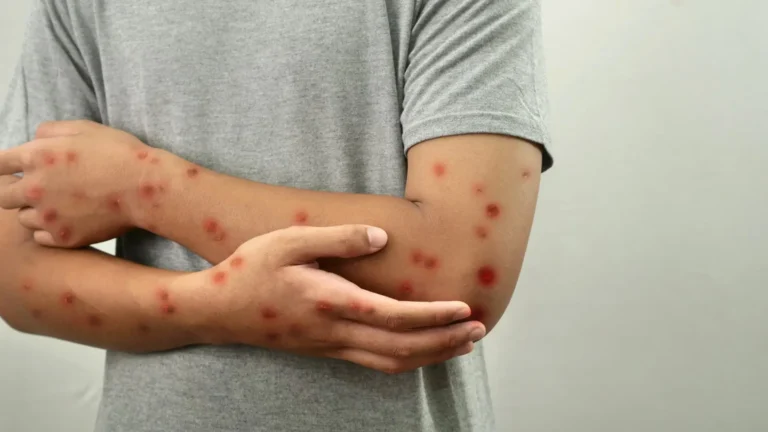 South Carolina sees a sudden surge in measles cases: 100 cases in two days