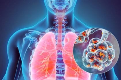 What is Legionnaires' disease? Its symptoms and how to prevent it after an outbreak in New York